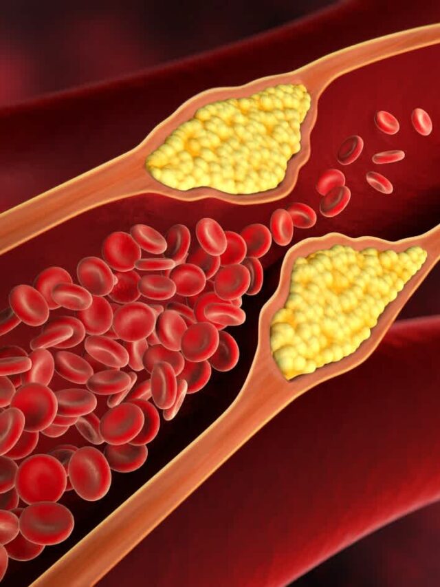 5 dangers of increased cholesterol in men